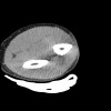 SPORK, NICO - 22.03.1976 - 02.08.2022 - CT obere Extremität - 17:56:57